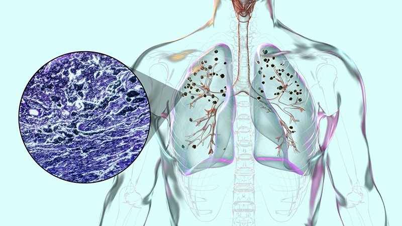 Silicosis